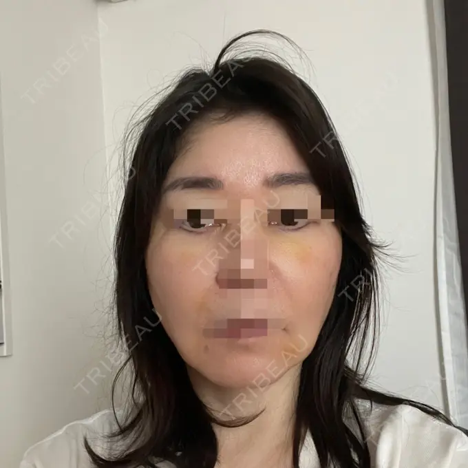 PRP皮膚再生療法 恵聖会クリニック 京橋院 DAY 5 メイン用