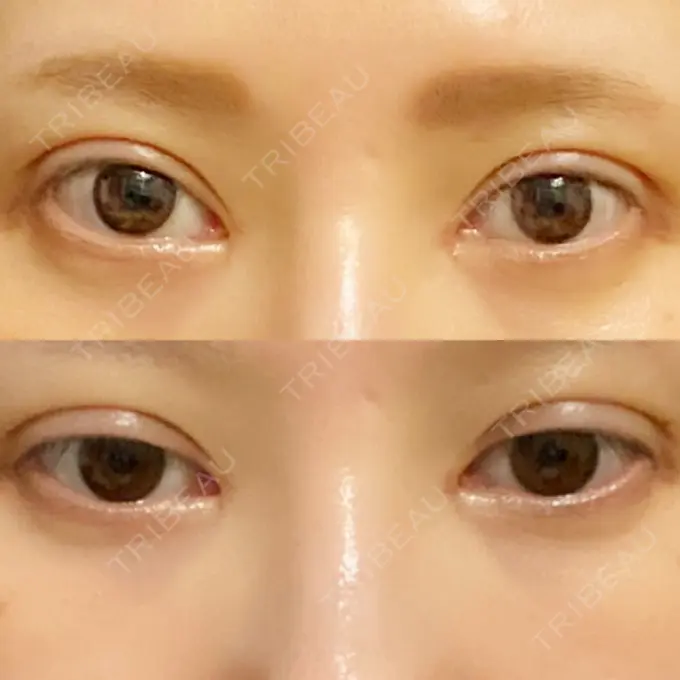 二重埋没 / 目頭切開 湘南メディカル記念病院（両国） DAY 35 メイン用