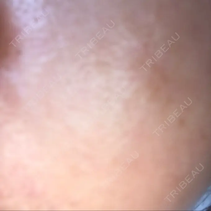 ダーマペン 湘南美容クリニック 武蔵小杉院 DAY 6 メイン用