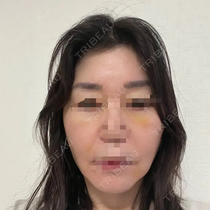 PRP皮膚再生療法 恵聖会クリニック 京橋院 DAY 7 メイン用