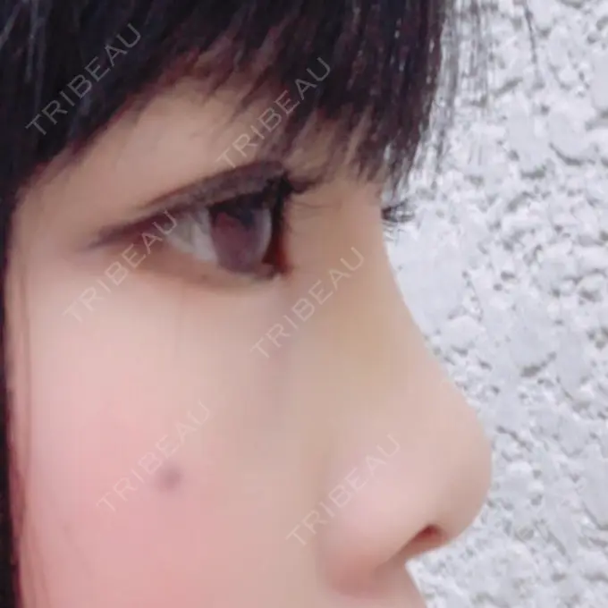 隆鼻術 湘南美容クリニック 柏院 AFTER メイン用