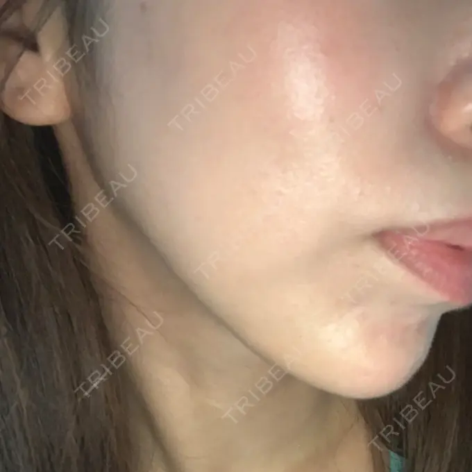 糸リフト MIL CLINIC OSAKA DAY 35 メイン用