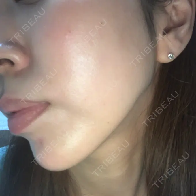 糸リフト MIL CLINIC OSAKA DAY 35 メイン用