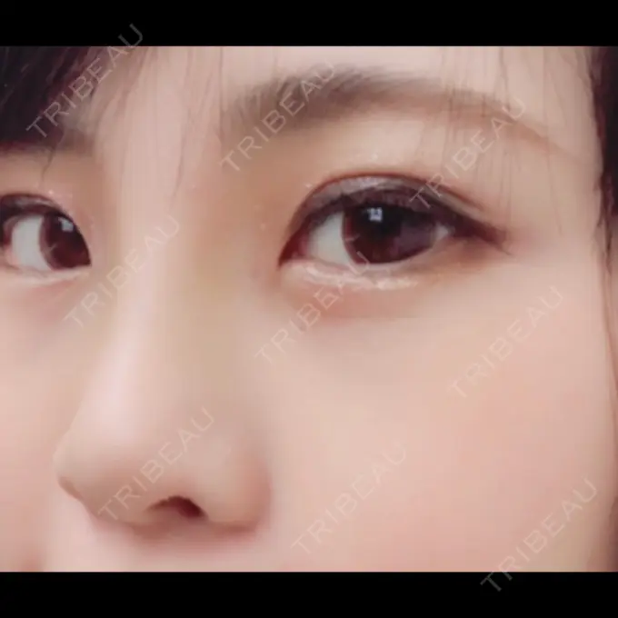 隆鼻術 湘南美容クリニック 柏院 DAY 5 メイン用