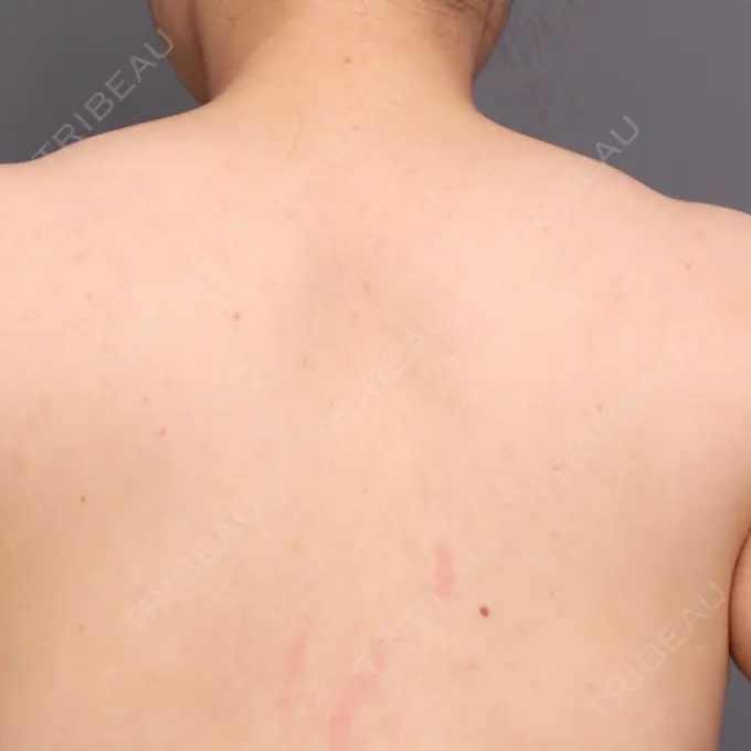 その他（ボディ） THE CLINIC（ザ・クリニック） 福岡院 DAY 14 メイン用