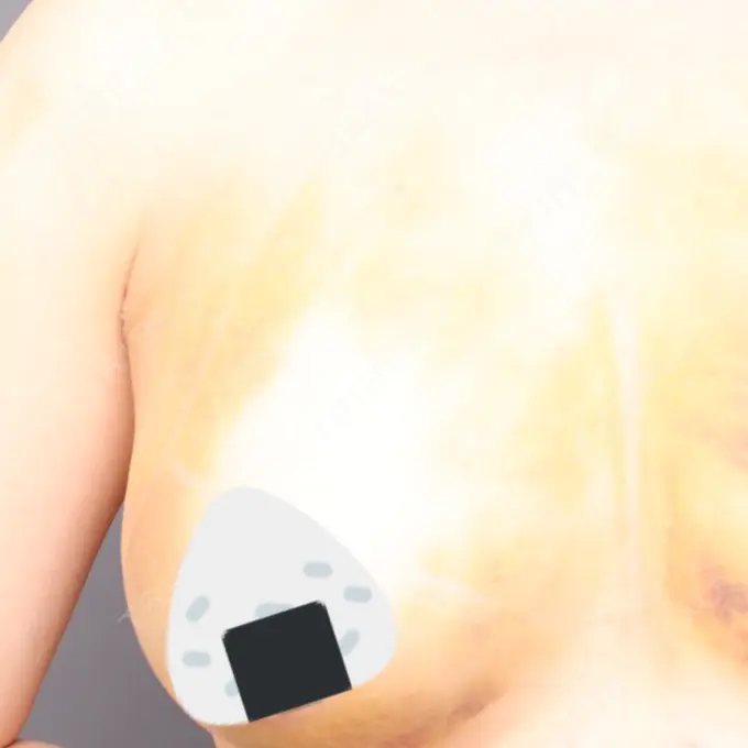 豊胸（脂肪注入） THE CLINIC（ザ・クリニック） 福岡院 DAY 7 メイン用