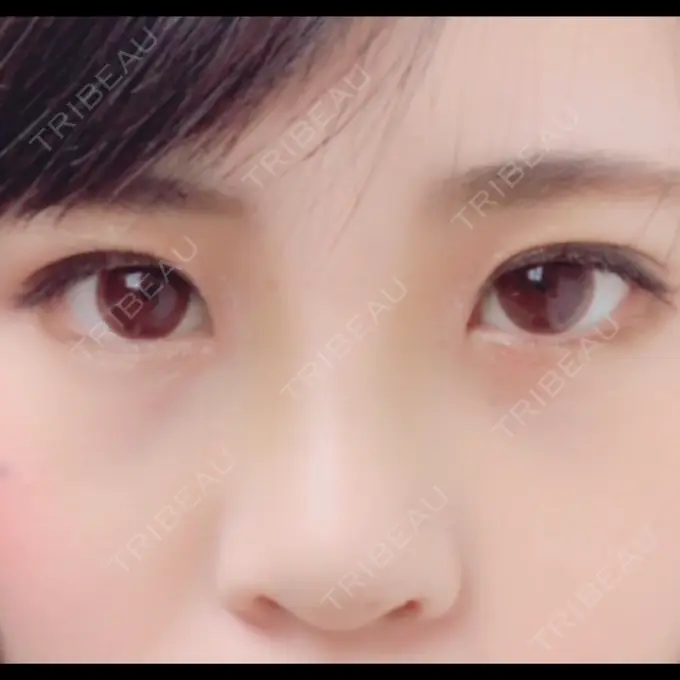 隆鼻術 湘南美容クリニック 柏院 DAY 5 メイン用