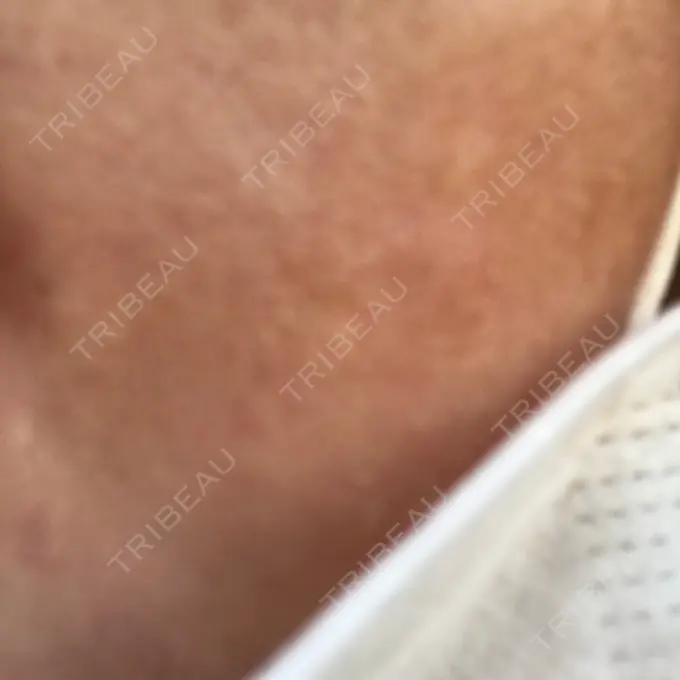 ダーマペン 湘南美容クリニック 武蔵小杉院 DAY 7 メイン用