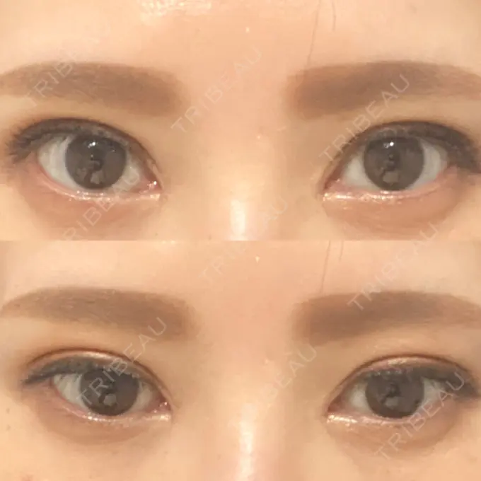 二重埋没 / 目頭切開 湘南メディカル記念病院（両国） DAY 38 メイン用