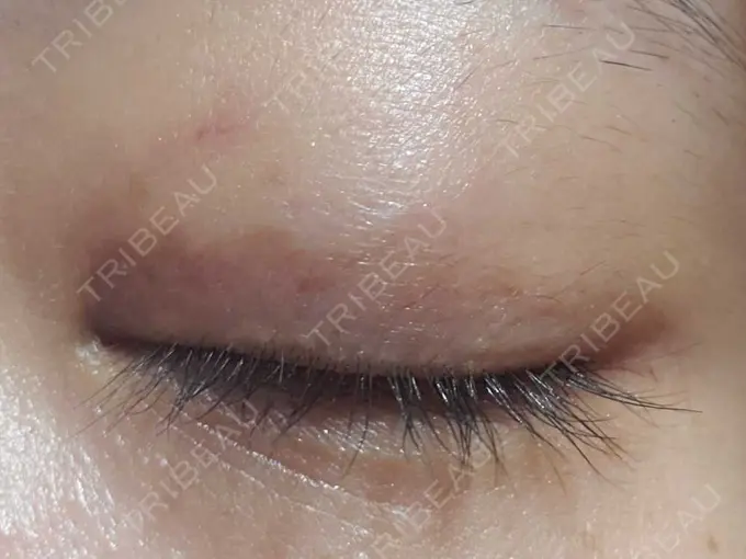 二重埋没 湘南美容クリニック 橋本院 DAY 14 メイン用