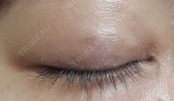 二重埋没 湘南美容クリニック 橋本院 DAY 14 メイン用