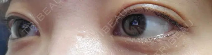 二重埋没 湘南美容クリニック 橋本院 DAY 14 メイン用