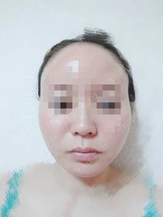 糸リフト TCB東京中央美容外科 八王子院 DAY 11 メイン用