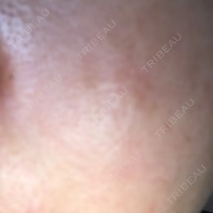 ダーマペン 湘南美容クリニック 武蔵小杉院 AFTER メイン用