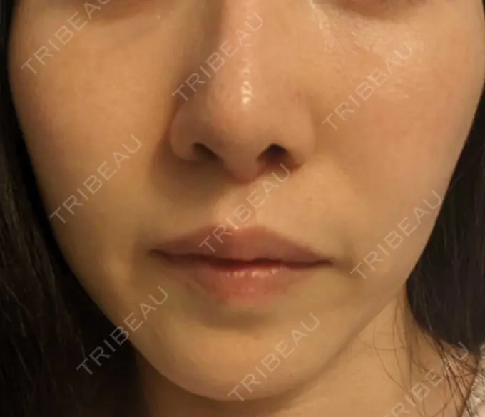 糸リフト / ボトックス（あご） / ヒアルロン酸注入（あご） フローラクリニック DAY 18 メイン用