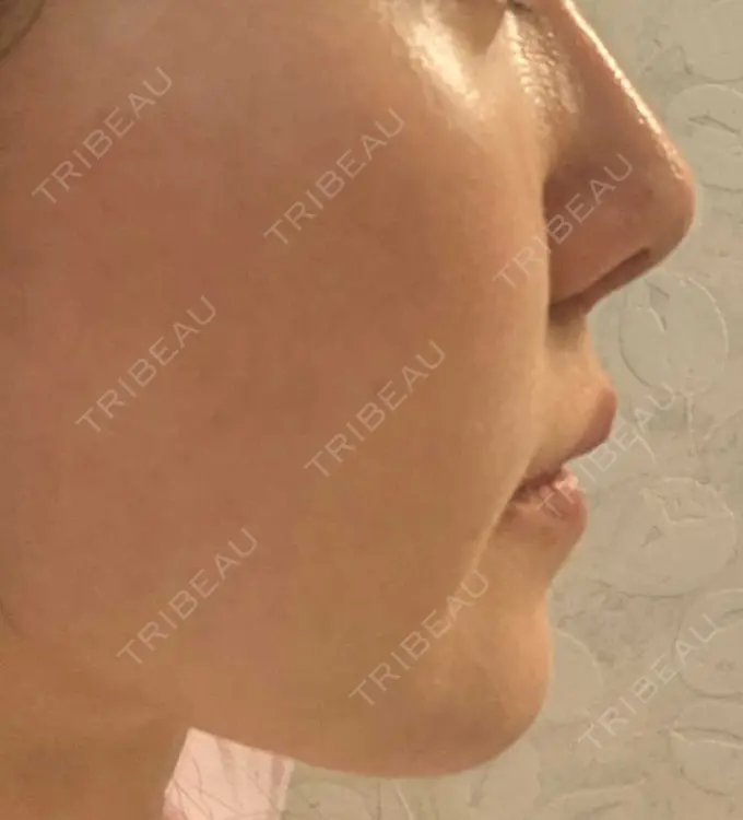 糸リフト / ボトックス（あご） / ヒアルロン酸注入（あご） フローラクリニック DAY 18 メイン用