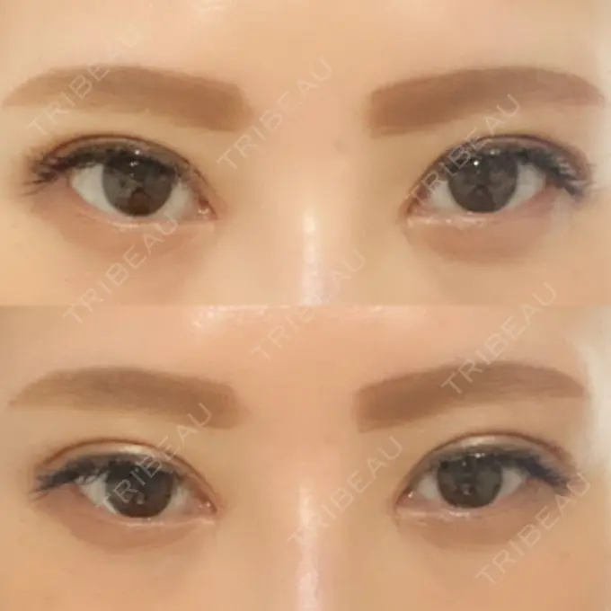 二重埋没 / 目頭切開 湘南メディカル記念病院（両国） DAY 39 メイン用