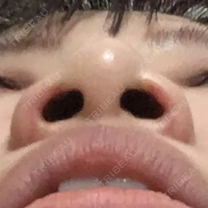 鼻孔縁挙上 シエルクリニック DAY 27 メイン用