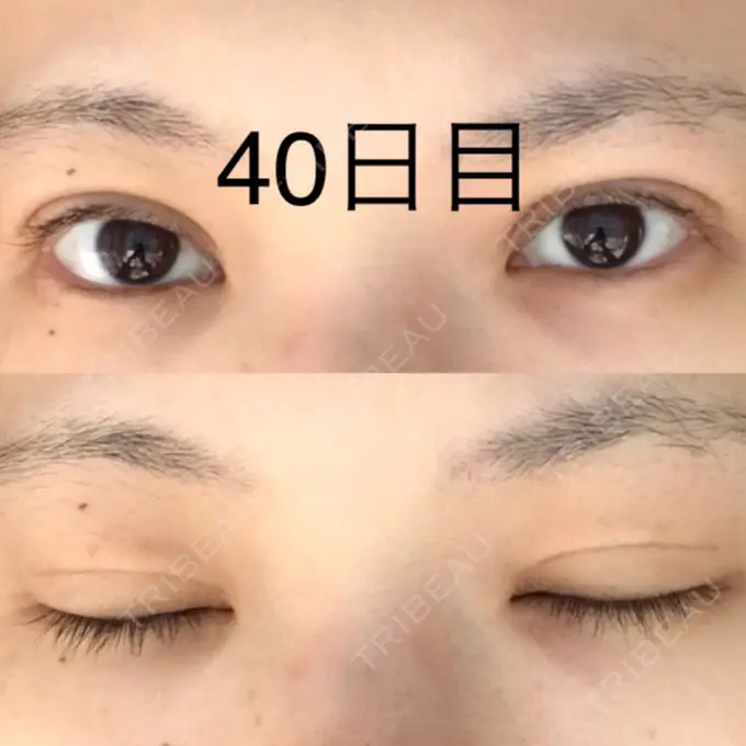 二重切開 / 上まぶたたるみ取り / 上まぶたの脂肪取り 城本クリニック 豊橋院 DAY 40 メイン用