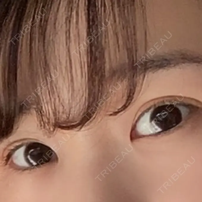 二重埋没 湘南メディカル記念病院（両国） AFTER メイン用