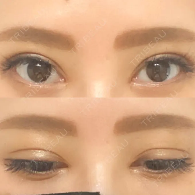 二重埋没 / 目頭切開 湘南メディカル記念病院（両国） DAY 43 メイン用