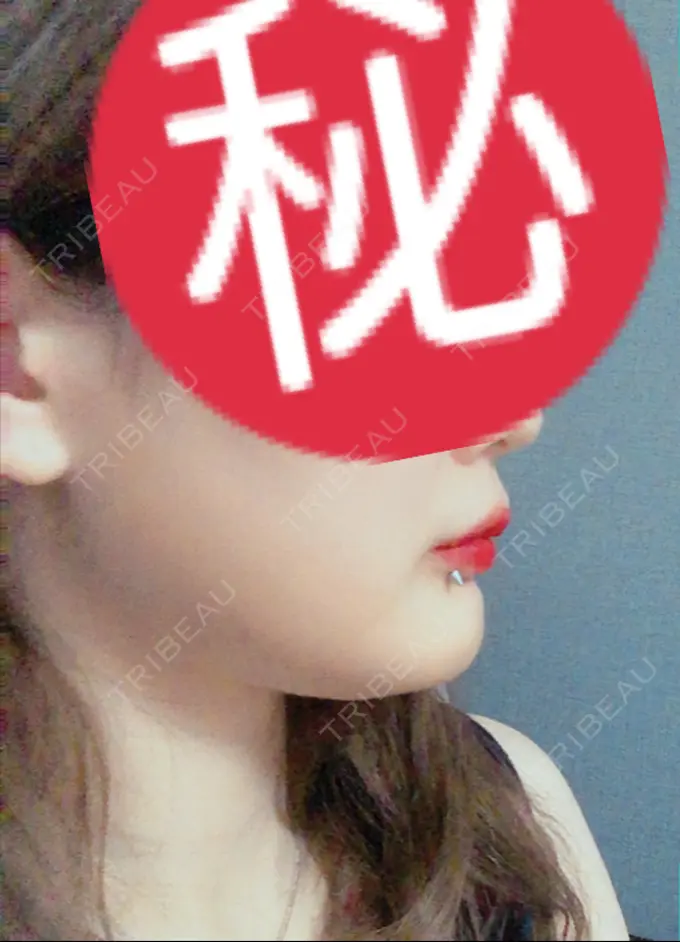 骨切り（あご） アーククリニック DAY 99 メイン用