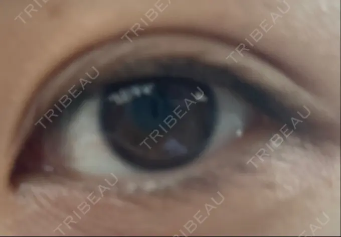 二重埋没 城本クリニック 福岡院 DAY 278 メイン用