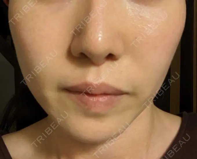 糸リフト / ボトックス（あご） / ヒアルロン酸注入（あご） フローラクリニック DAY 24 メイン用