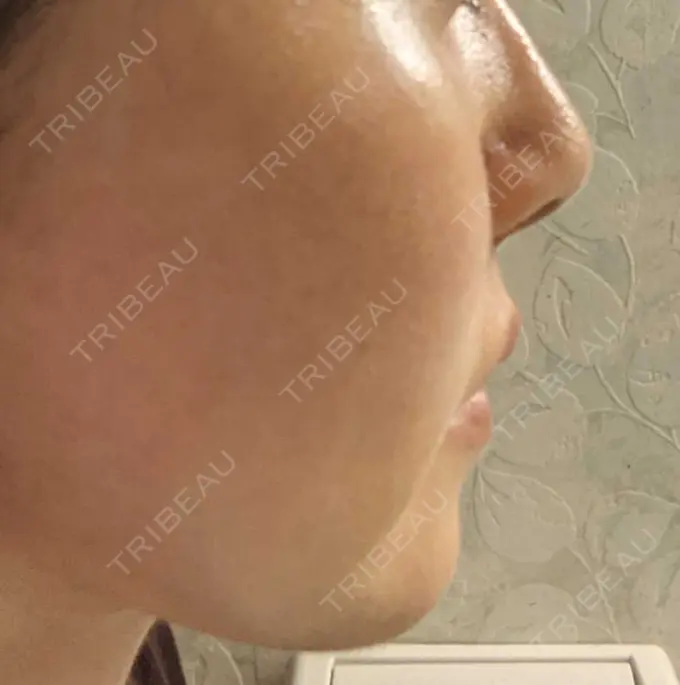 糸リフト / ボトックス（あご） / ヒアルロン酸注入（あご） フローラクリニック DAY 24 メイン用