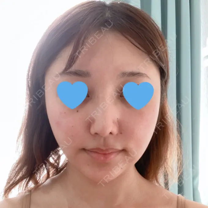 隆鼻術 / 鼻中隔延長（切開） / 軟骨移植 / ワシ鼻修正・ハンプ切除 みずほクリニック DAY 44 メイン用