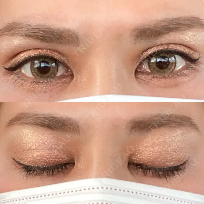 二重埋没 城本クリニック 福岡院 DAY 9 メイン用