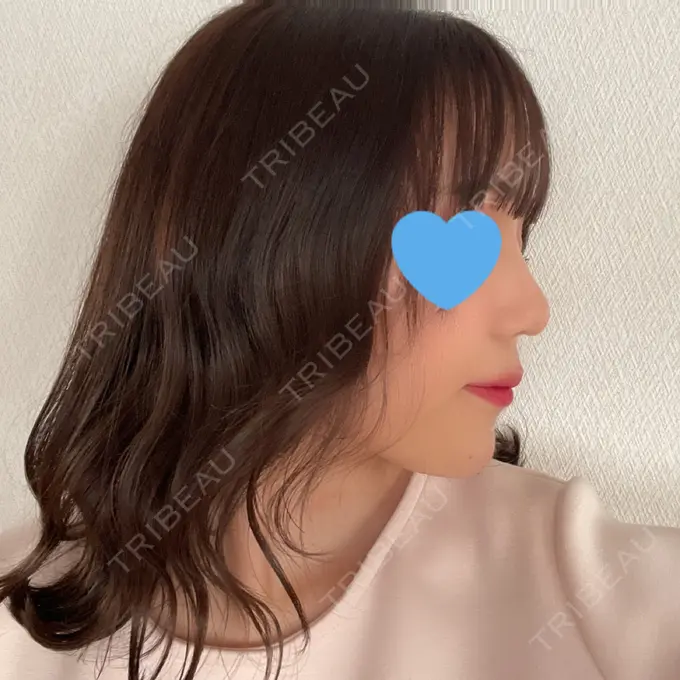 隆鼻術 / 鼻尖形成（切開） / 鼻中隔延長（切開） / 軟骨移植 湘南美容クリニック 名古屋栄院 AFTER メイン用
