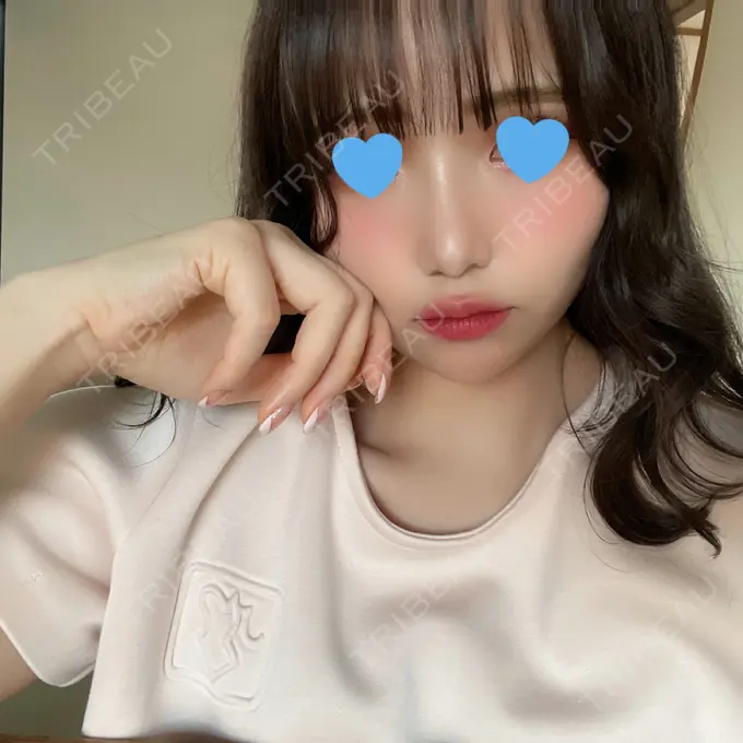 隆鼻術 / 鼻尖形成（切開） / 鼻中隔延長（切開） / 軟骨移植 湘南美容クリニック 名古屋栄院 DAY 100 メイン用