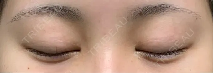 ヒアルロン酸注入（涙袋） アネシス美容クリニック DAY 1 メイン用