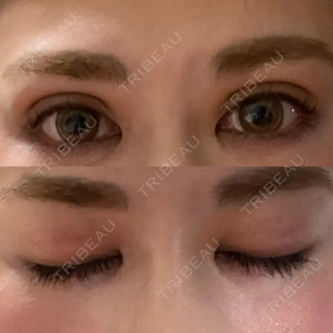 二重埋没 城本クリニック 福岡院 DAY 10 メイン用