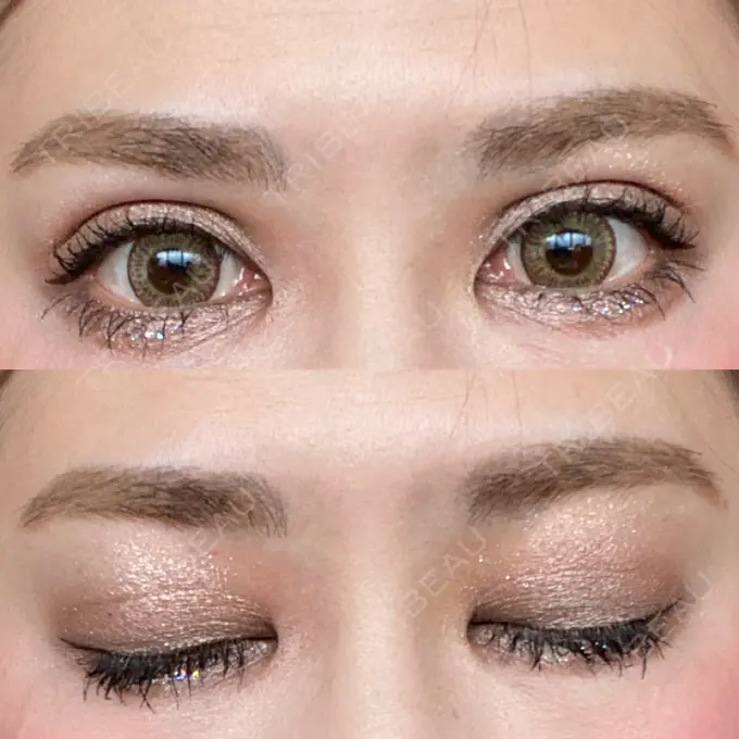 二重埋没 城本クリニック 福岡院 DAY 10 メイン用