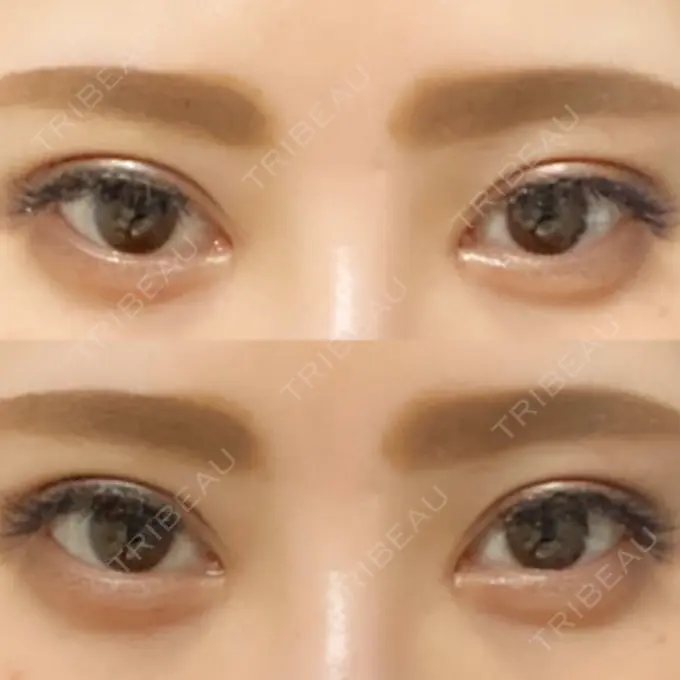 二重埋没 / 目頭切開 湘南メディカル記念病院（両国） DAY 48 メイン用