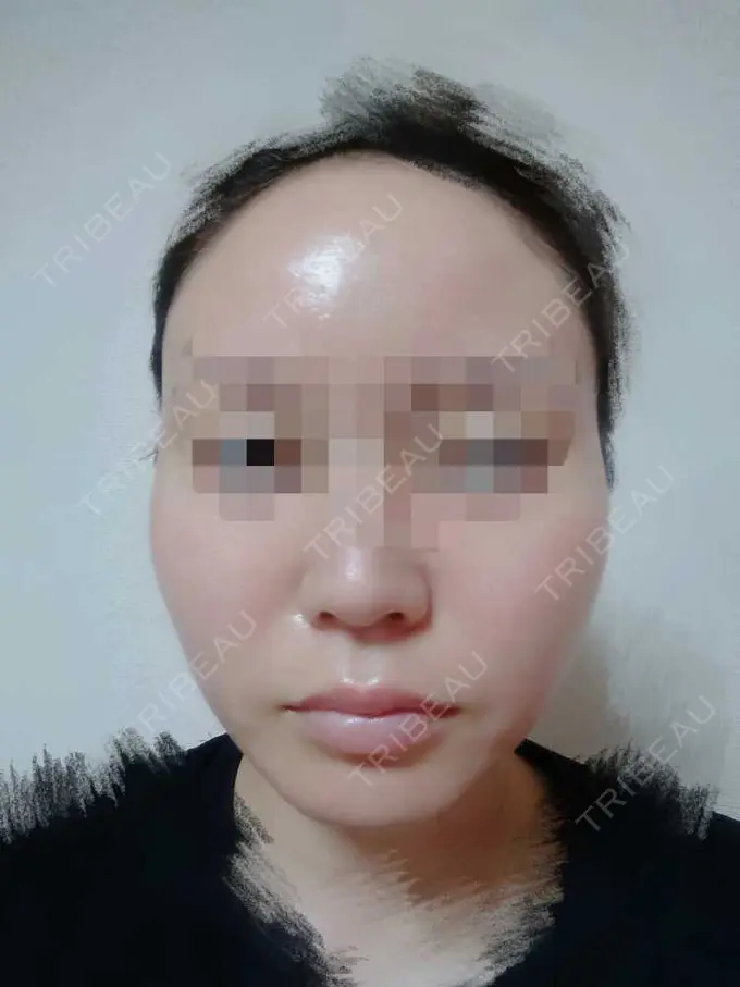 糸リフト TCB東京中央美容外科 八王子院 DAY 21 メイン用