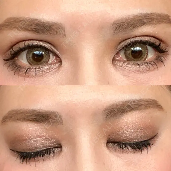 二重埋没 城本クリニック 福岡院 DAY 11 メイン用