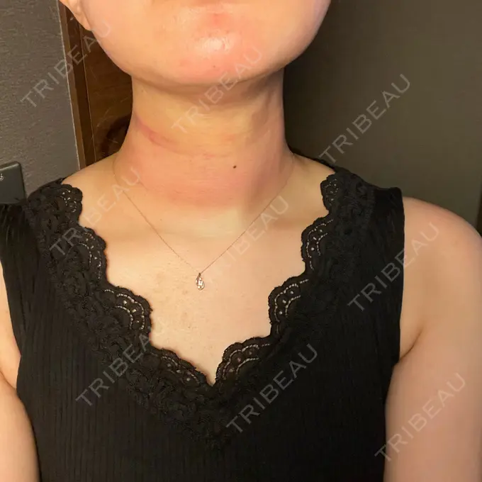 糸リフト / 脂肪吸引（顔） / メーラーファット除去 湘南美容クリニック 秋葉原院 DAY 1 メイン用