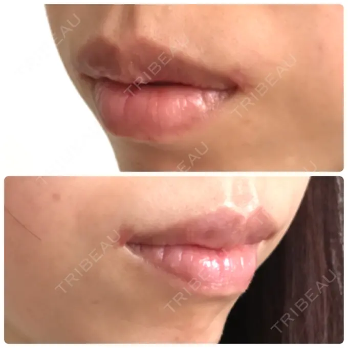 口角挙上 / その他（口元） eクリニック 金沢本院 DAY 140 メイン用