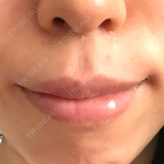 口角挙上 / その他（口元） eクリニック 金沢本院 DAY 140 メイン用