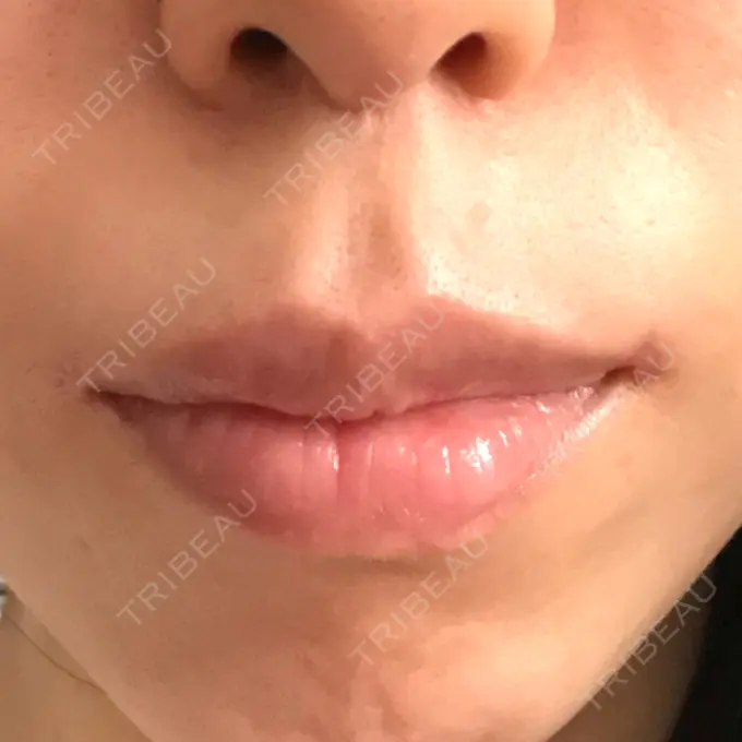 口角挙上 / その他（口元） eクリニック 金沢本院 DAY 140 メイン用