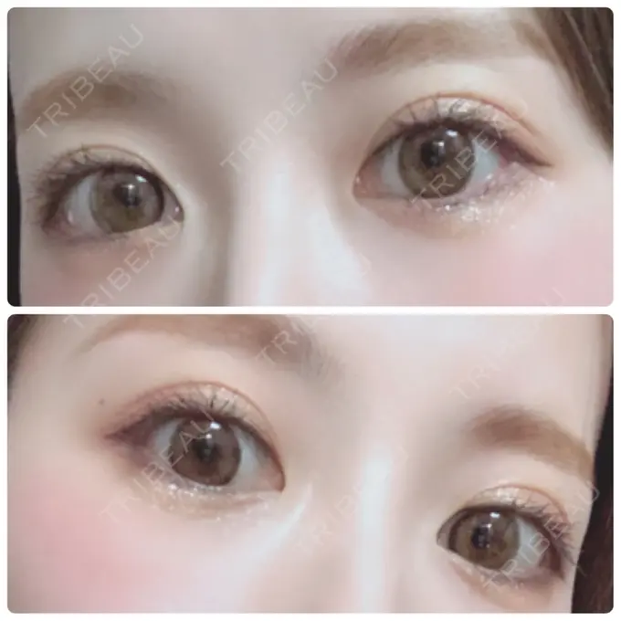 二重埋没 X CLINIC 恵比寿院 AFTER メイン用