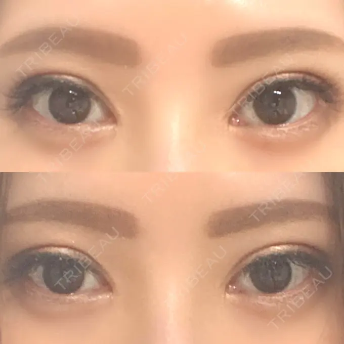 二重埋没 / 目頭切開 湘南メディカル記念病院（両国） DAY 50 メイン用