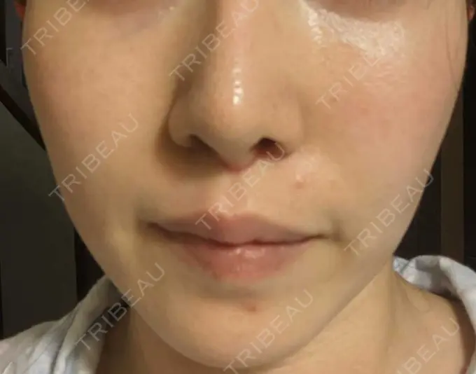 糸リフト / ボトックス（あご） / ヒアルロン酸注入（あご） フローラクリニック DAY 29 メイン用