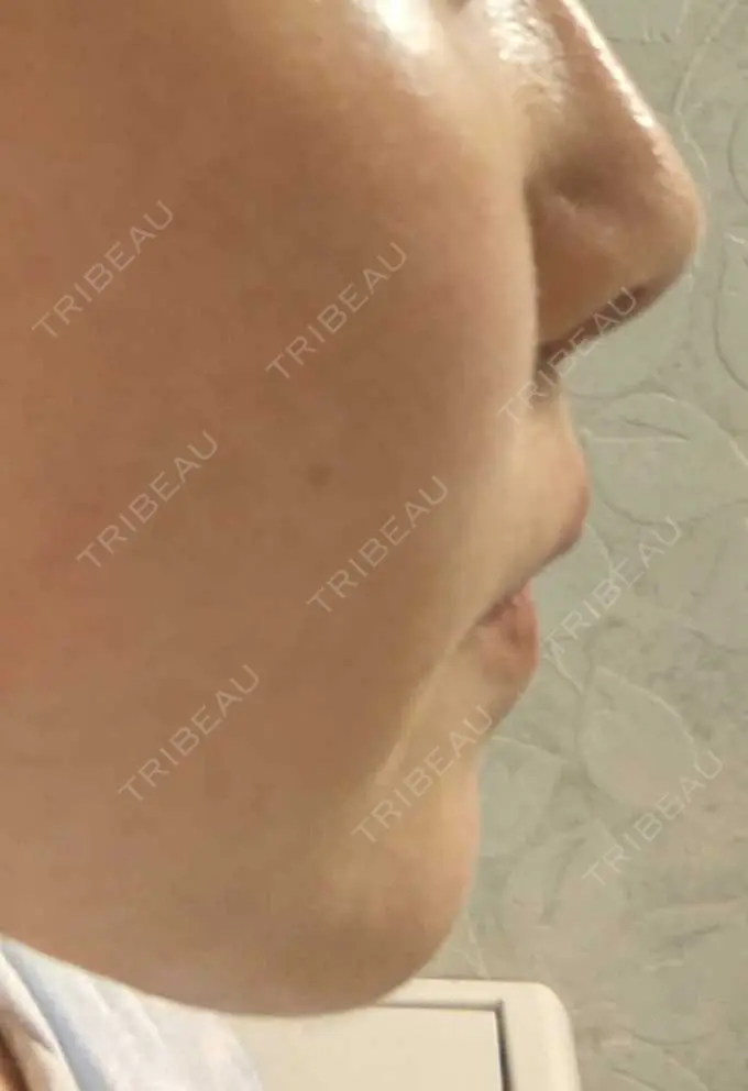 糸リフト / ボトックス（あご） / ヒアルロン酸注入（あご） フローラクリニック DAY 29 メイン用