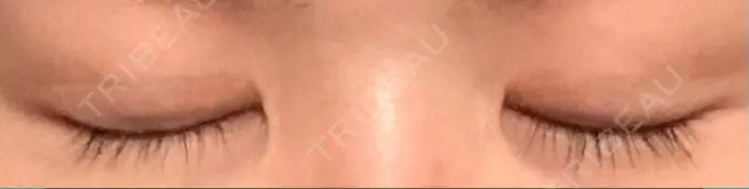 二重切開 / 上まぶたの脂肪取り 城本クリニック 豊橋院 DAY 217 メイン用