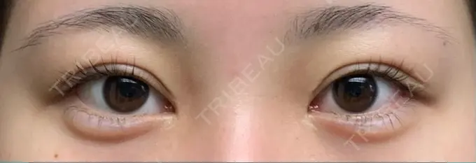 ヒアルロン酸注入（涙袋） アネシス美容クリニック DAY 4 メイン用