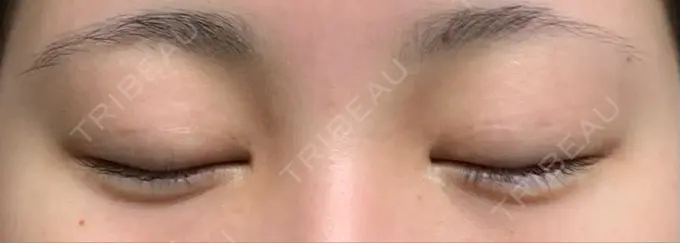 ヒアルロン酸注入（涙袋） アネシス美容クリニック DAY 4 メイン用